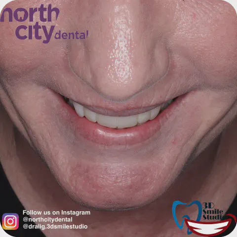 Smile before and after composite bonding for spacing and exposed root surfaces