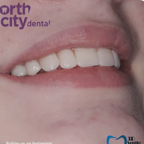 Before and after composite bonding used to close a gap between the upper front teeth