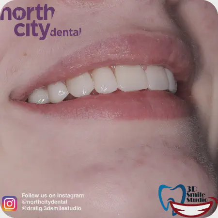 Smile makeover before and after case 1078 – composite bonding Dublin