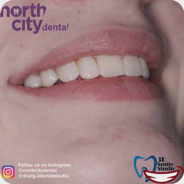 Before and after composite bonding used to close a gap between the upper front teeth