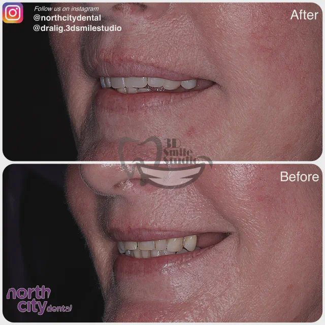 Left-side dental view before and after composite bonding