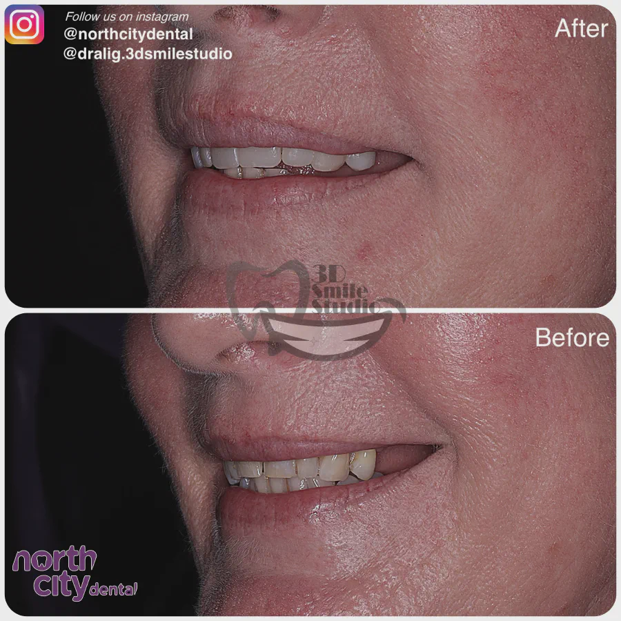 Smile makeover before and after case 1068 – composite bonding Dublin