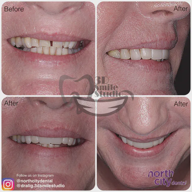 Multiple views of spacing and tooth proportions before and after composite bonding
