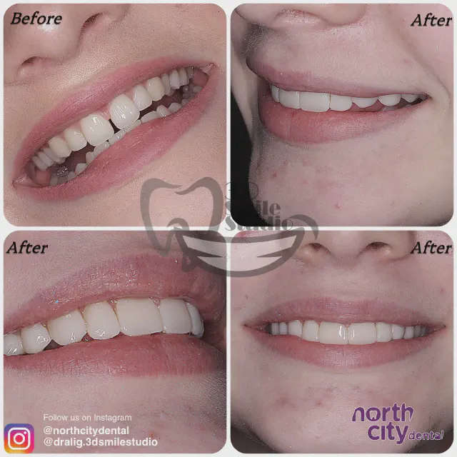 Multiple views of the front-tooth gap before and after composite bonding
