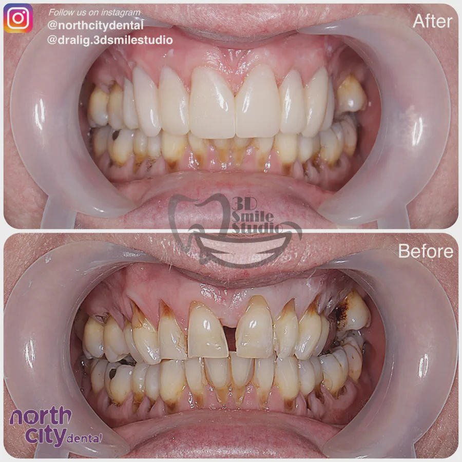 Smile makeover before and after case 1068 – composite bonding Dublin