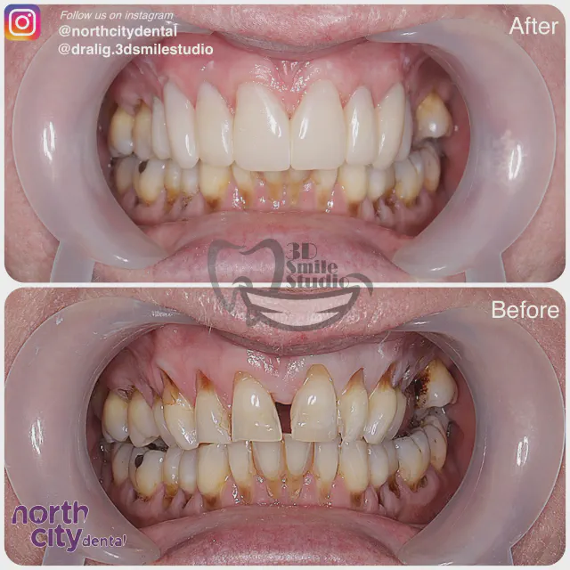 Retracted dental view before and after composite bonding for spacing