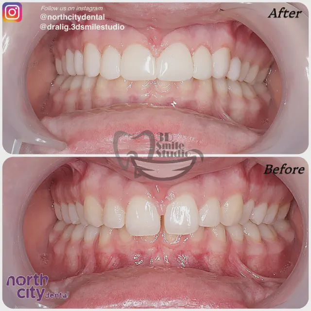 Retracted dental view before and after composite bonding on the upper front teeth