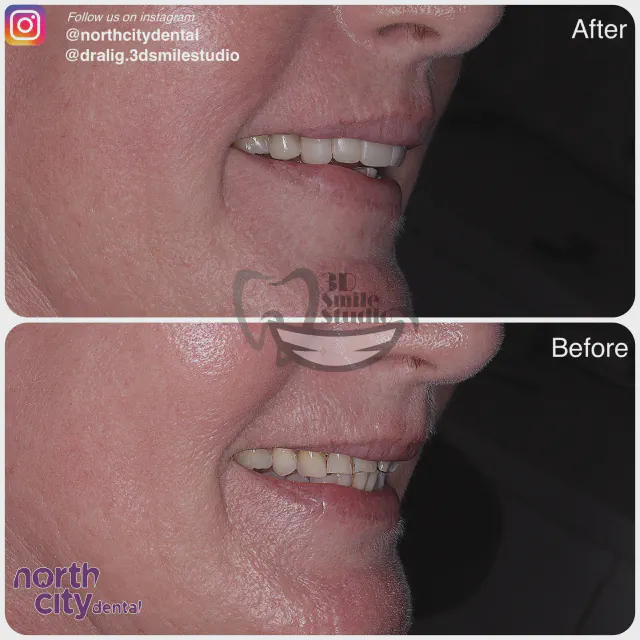 Right-side dental view before and after composite bonding
