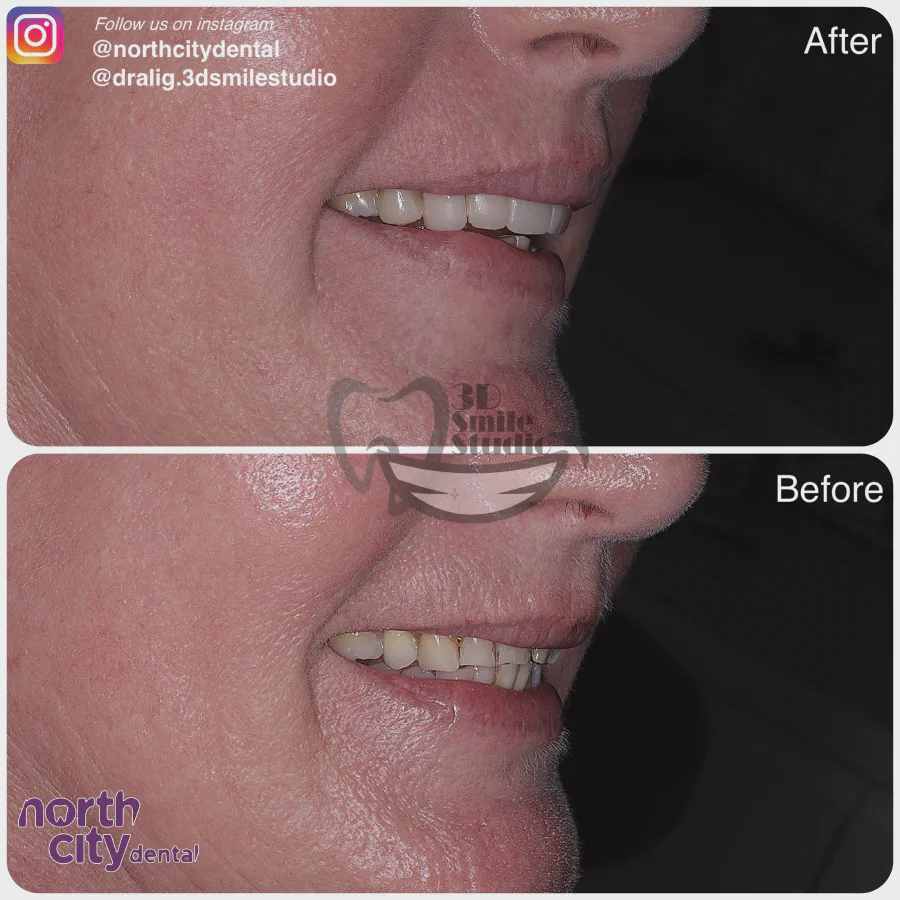 Smile makeover before and after case 1068 – composite bonding Dublin