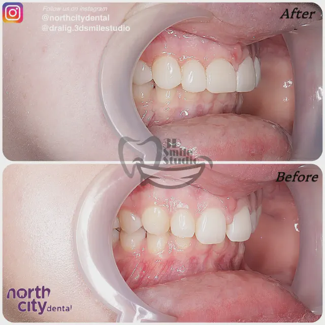 Right-side view of the upper front teeth before and after composite bonding