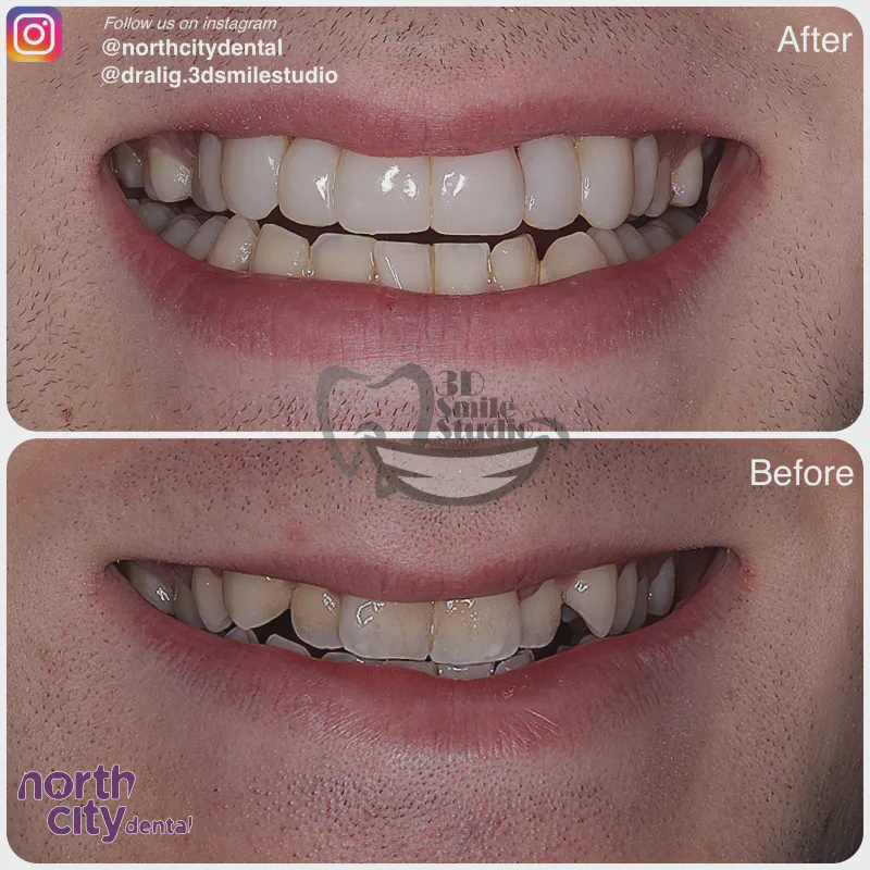 Smile makeover before and after case 1075 – composite bonding Dublin