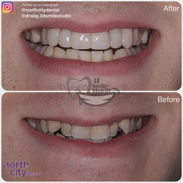 Front smile view before and after composite bonding to improve alignment