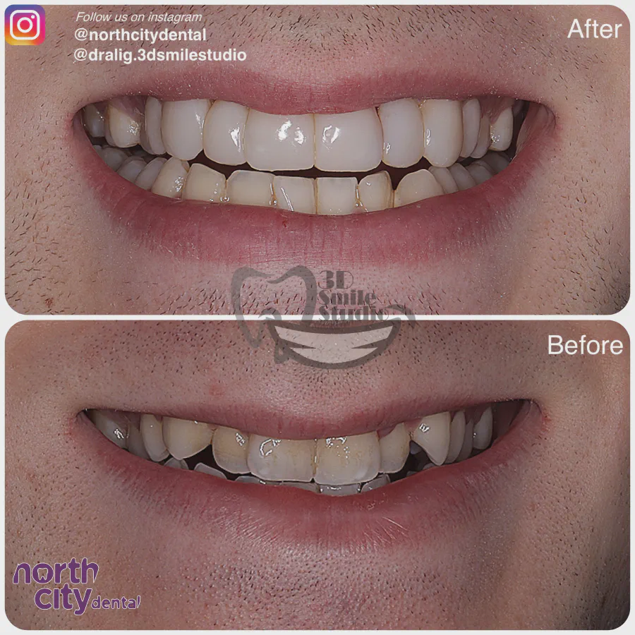 Smile makeover before and after case 1075 – composite bonding Dublin