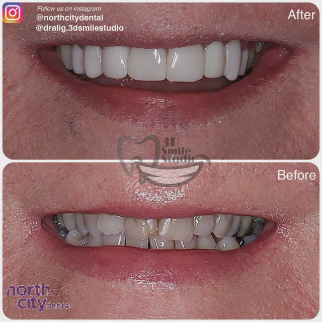 Front smile view before and after composite bonding for fractured tooth surfaces