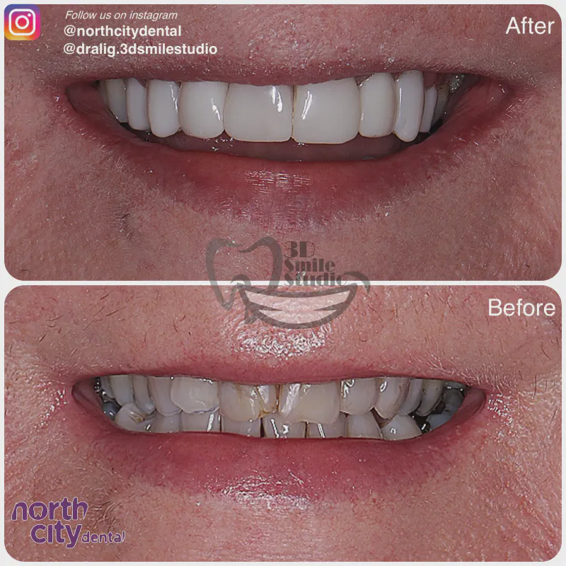 Smile makeover before and after case 1078 – composite bonding Dublin