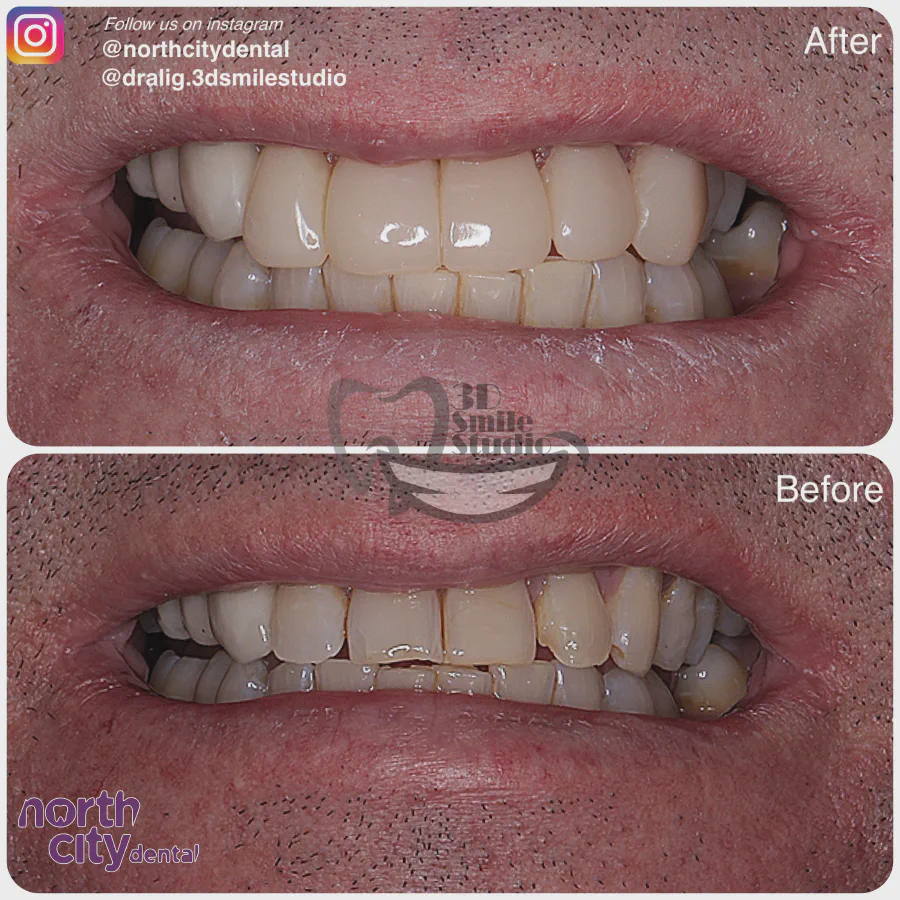 Smile makeover before and after case 1079 – composite bonding Dublin