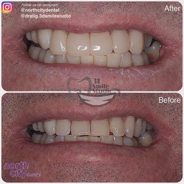 Front smile view before and after composite bonding for worn tooth edges