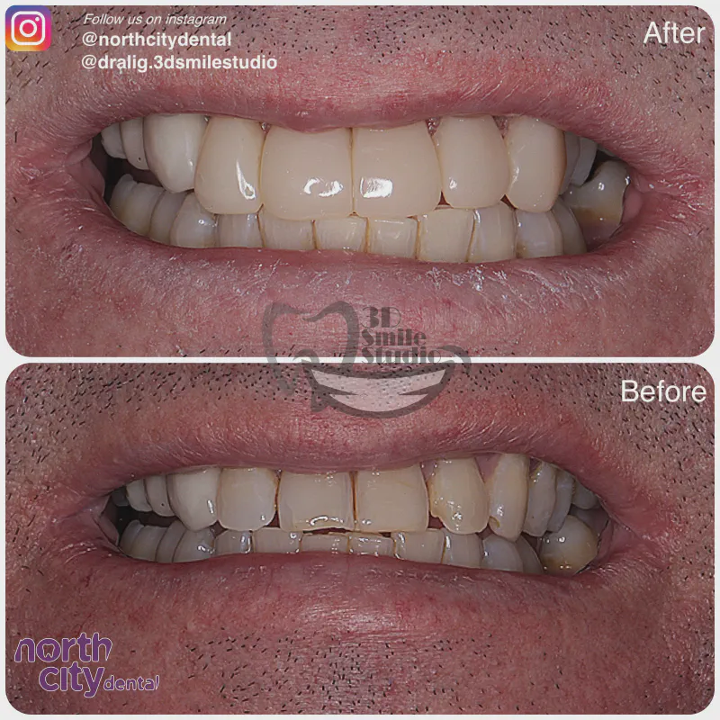 Smile makeover before and after case 1078 – composite bonding Dublin