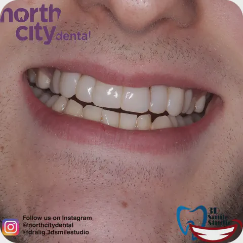 Smile before and after composite bonding for uneven lateral incisors