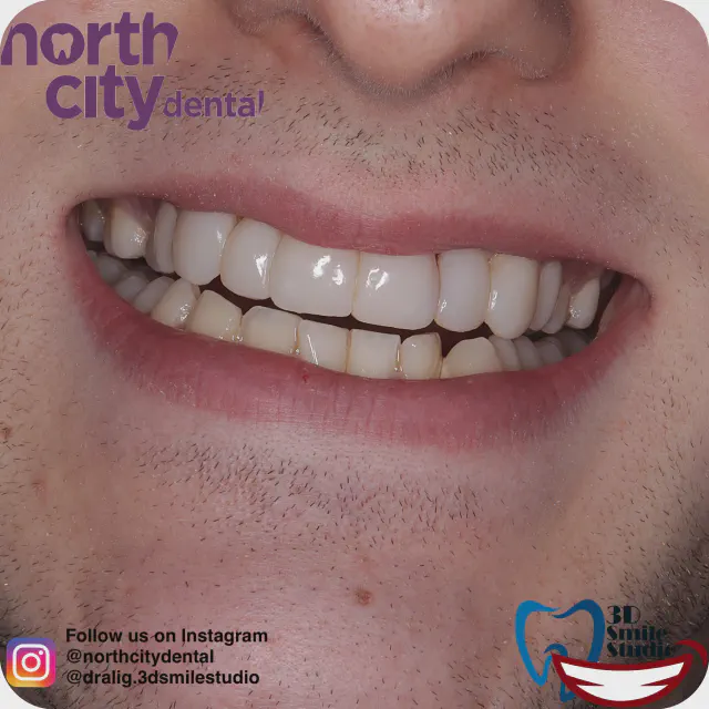 Smile before and after composite bonding for uneven lateral incisors