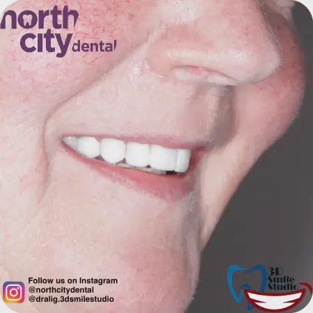 Smile makeover before and after case 1078 – composite bonding Dublin