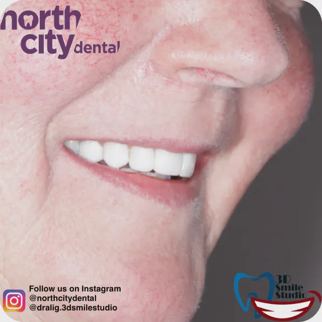 Smile before and after composite bonding for fractured and previously restored teeth
