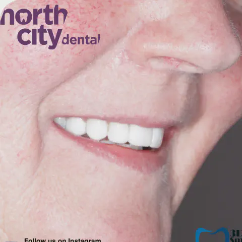 Smile before and after composite bonding for fractured and previously restored teeth