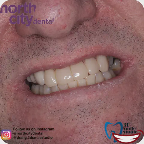 Smile before and after five composite bondings beside an existing dental bridge