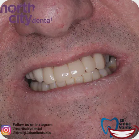 Smile makeover before and after case 1078 – composite bonding Dublin