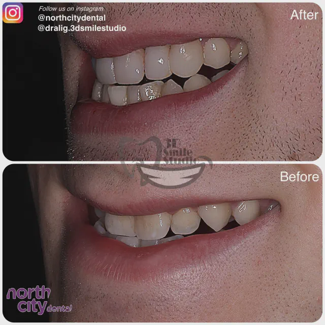 Left-side smile view before and after composite bonding