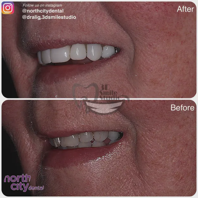 Left-side smile view before and after composite bonding