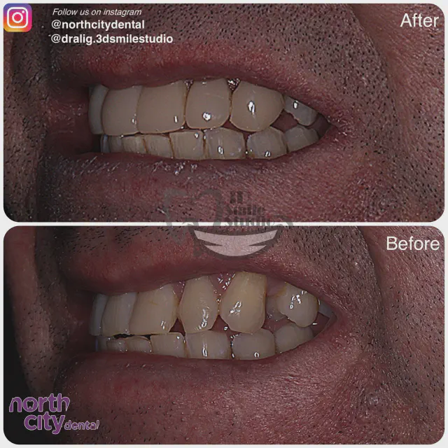 Left-side smile view before and after composite bonding