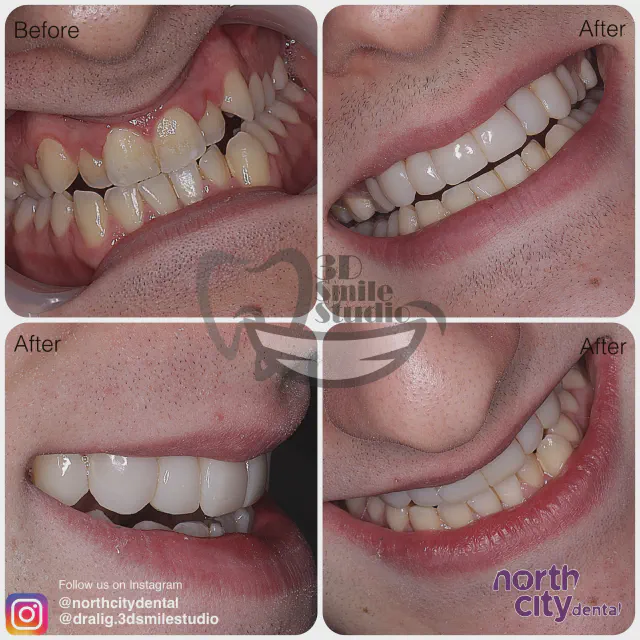 Multiple views of uneven lateral incisors before and after composite bonding