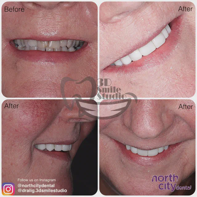 Multiple views of fractured and restored teeth before and after composite bonding