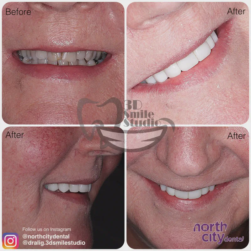 Smile makeover before and after case 1078 – composite bonding Dublin