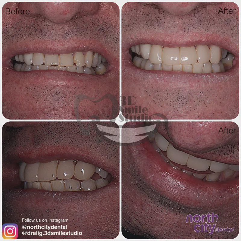 Smile makeover before and after case 1078 – composite bonding Dublin