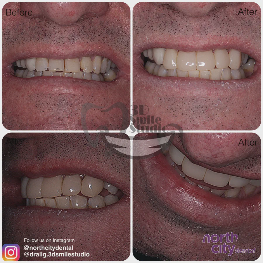 Smile makeover before and after case 1079 – composite bonding Dublin