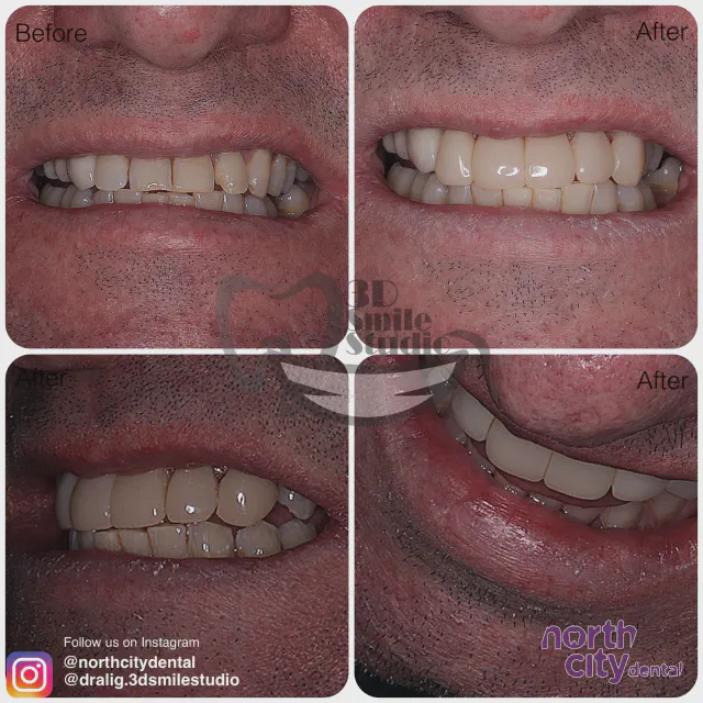 Multiple views of worn tooth edges before and after composite bonding