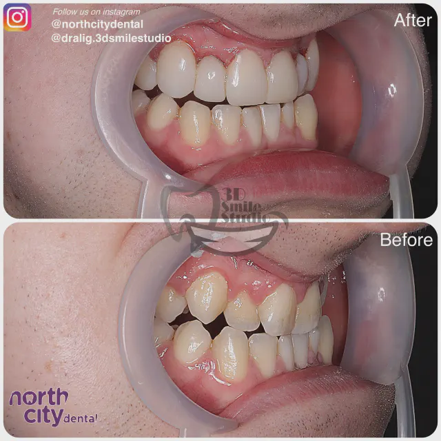 Retracted dental view before and after composite bonding on the lateral incisors