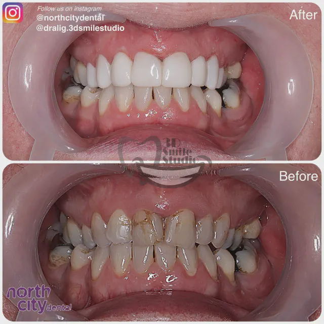 Retracted dental view before and after composite bonding around existing restorations
