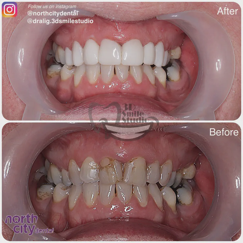 Smile makeover before and after case 1078 – composite bonding Dublin