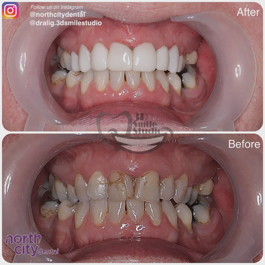 Smile makeover before and after case 1078 – composite bonding Dublin