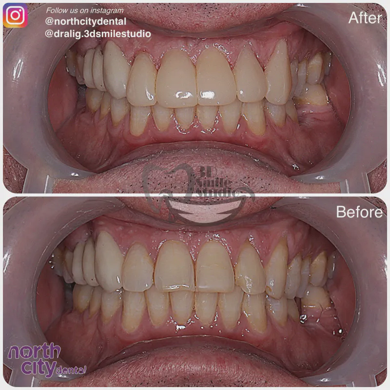 Smile makeover before and after case 1078 – composite bonding Dublin