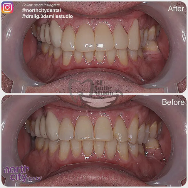 Retracted dental view before and after five composite bondings