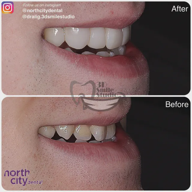 Right-side smile view before and after composite bonding