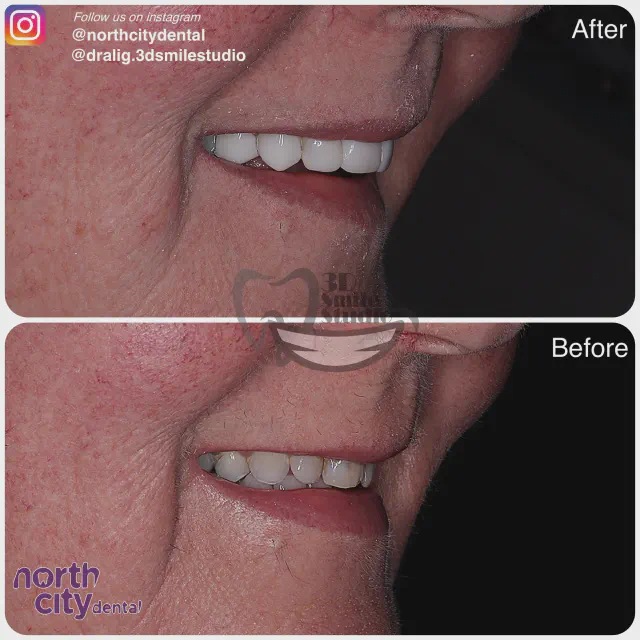 Right-side smile view before and after composite bonding