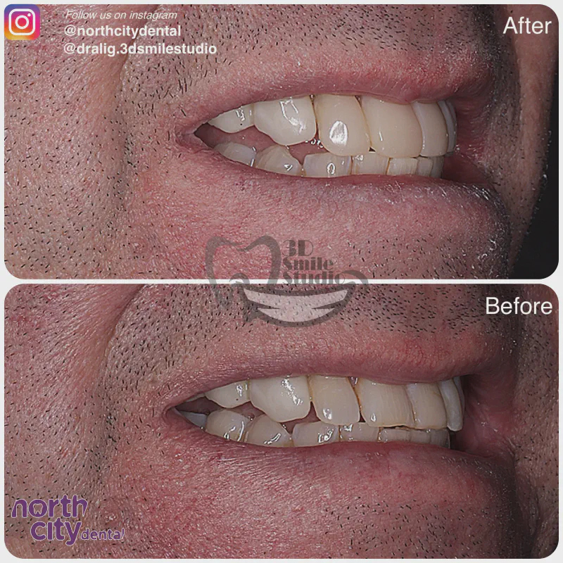 Smile makeover before and after case 1078 – composite bonding Dublin