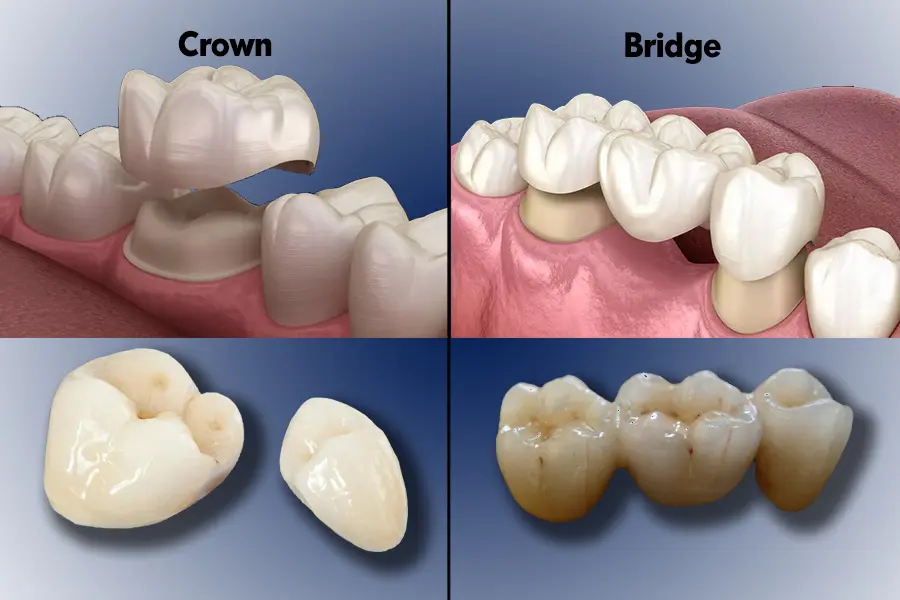 Crowns & Bridges